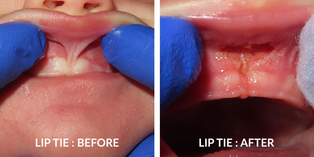 Frenectomy Before And After