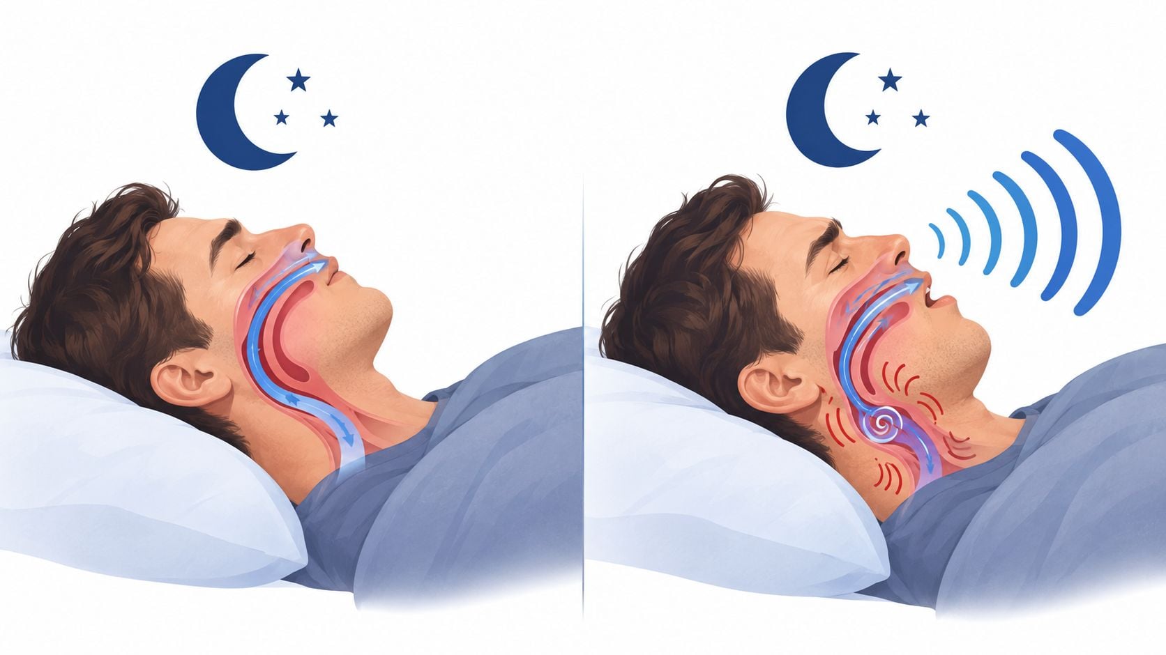 A side-by-side medical illustration comparing normal breathing and airway obstruction caused by snoring during sleep.