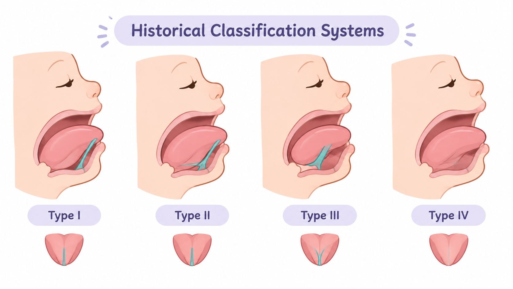 A diagram illustrating four types of historical tongue-tie classification systems based on frenulum attachment anatomy.